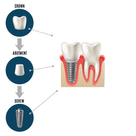Dental Implant Example